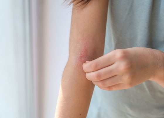 nemolizumab-shows-rapid,-sustained-efficacy-in-atopic-dermatitis