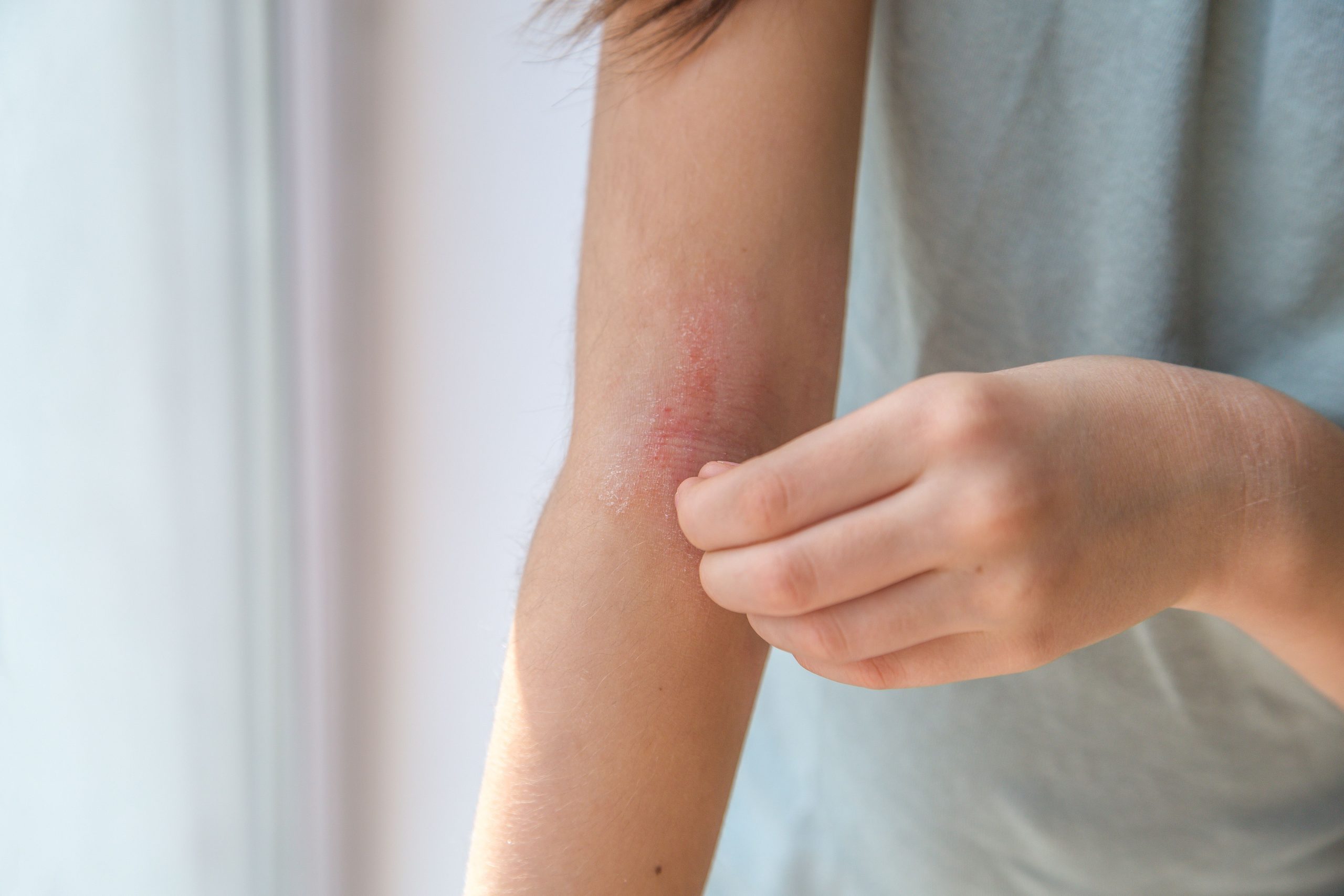 Nemolizumab Shows Rapid, Sustained Efficacy in Atopic Dermatitis