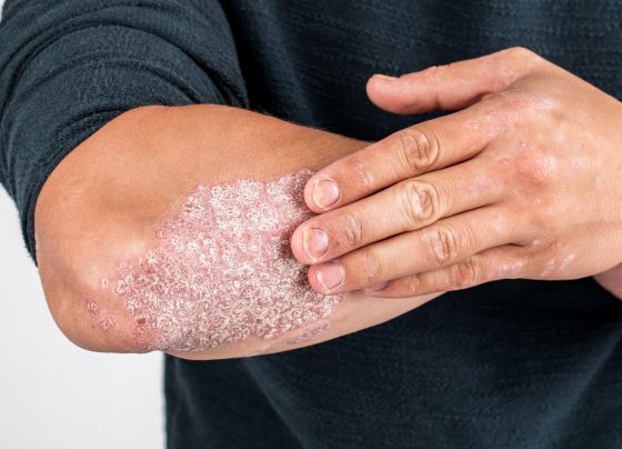 fda-approves-ustekinumab-stba,-biosimilar-to-stelara,-for-pediatric-patients-with-pso-or-psa