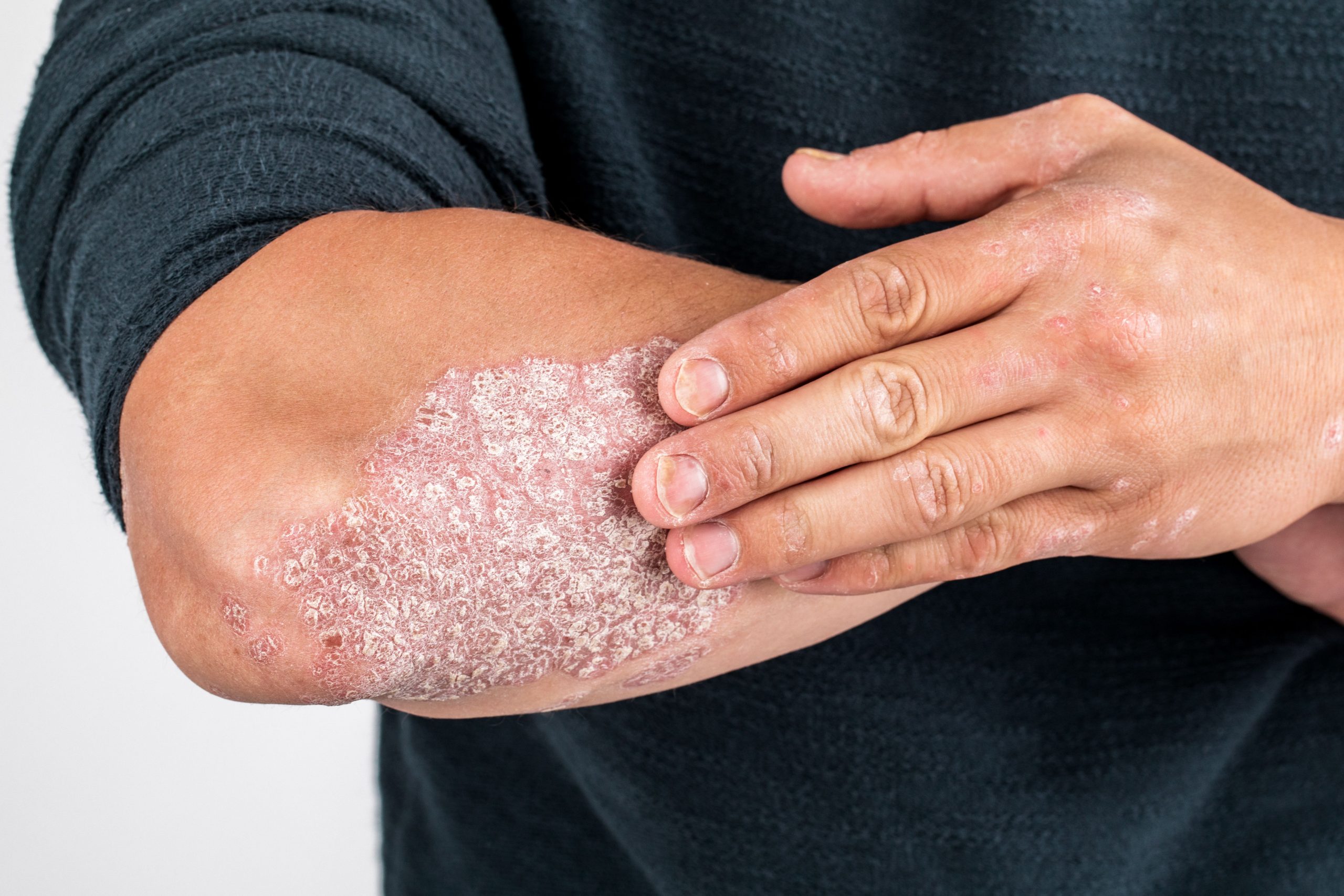 FDA Approves Ustekinumab-Stba, Biosimilar to Stelara, for Pediatric Patients With PsO or PsA