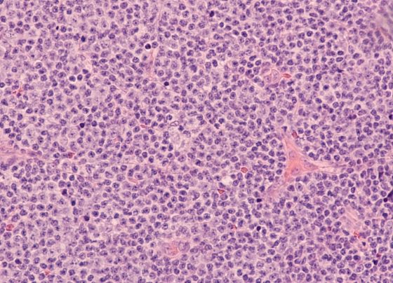 new-frontline-btk-inhibitor-strategy-gains-fda-approval-in-untreated-mantle-cell-lymphoma