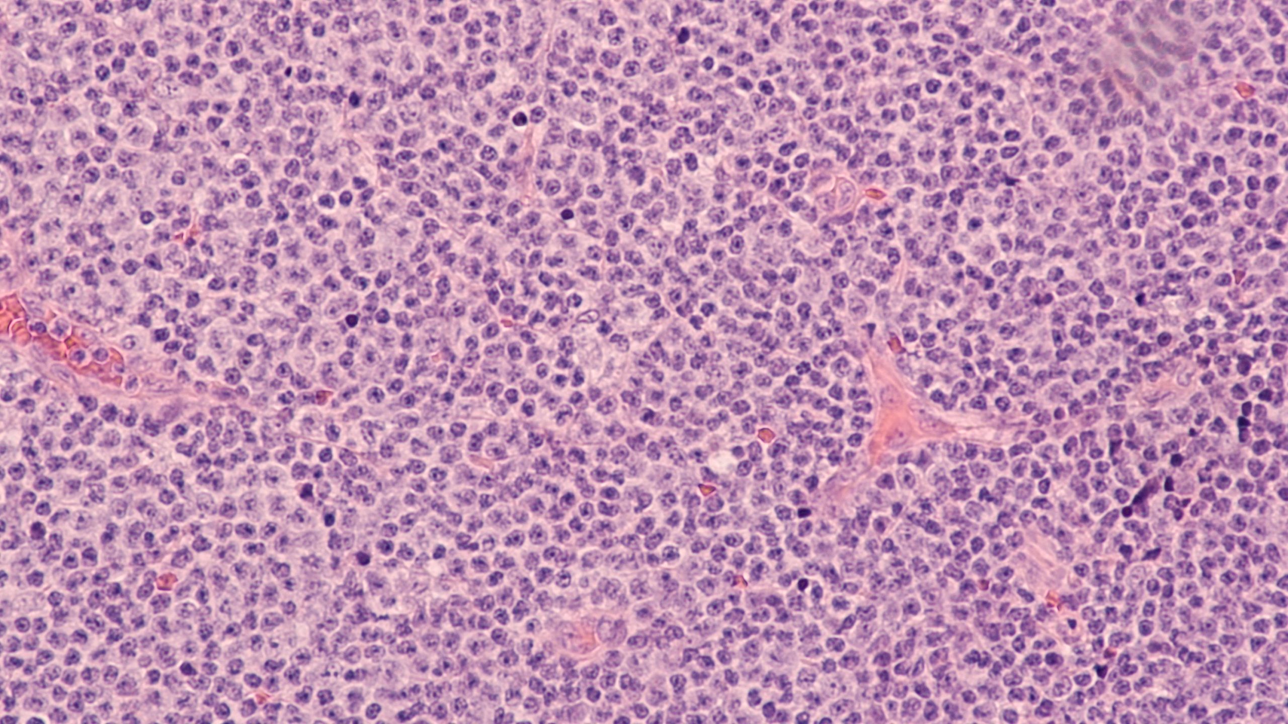 New Frontline BTK Inhibitor Strategy Gains FDA Approval in Untreated Mantle Cell Lymphoma