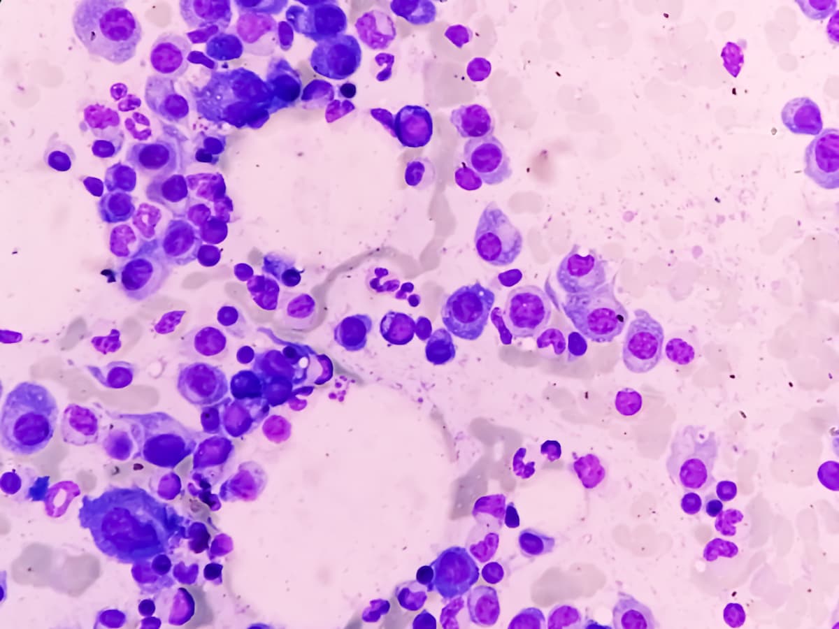 FDA Approves Linvoseltamab-Gcpt for Treatment of Relapsed or Refractory Multiple Myeloma