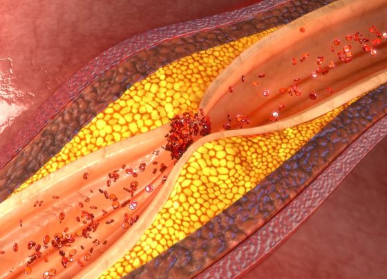 elevated-remnant-cholesterol,-lp-pla2-linked-to-heightened-risk-of-composite-adverse-events