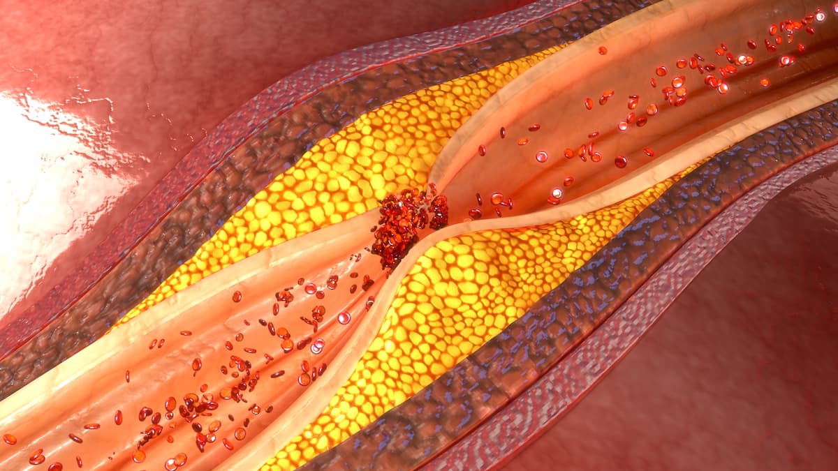 Elevated Remnant Cholesterol, Lp-PLA2 Linked to Heightened Risk of Composite Adverse Events