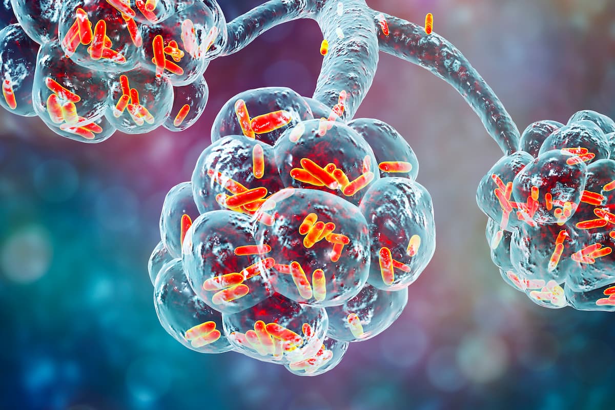 Hospitalized Adults With Community-Acquired Pneumonia Suffer Significant Morbidity Postdischarge