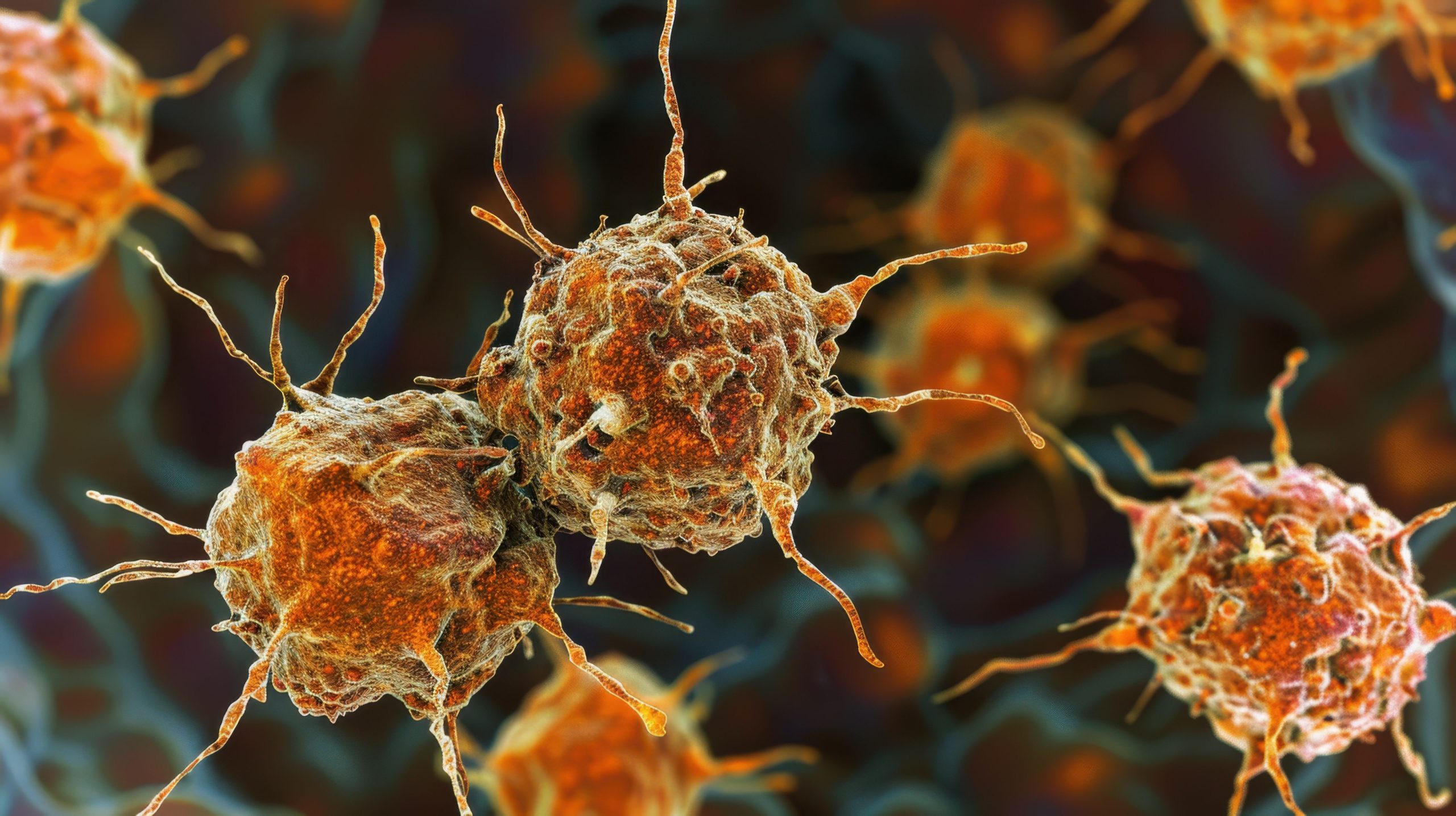 FDA Approves Y-90 Resin Microspheres for Unrespectable Hepatocellular Carcinoma