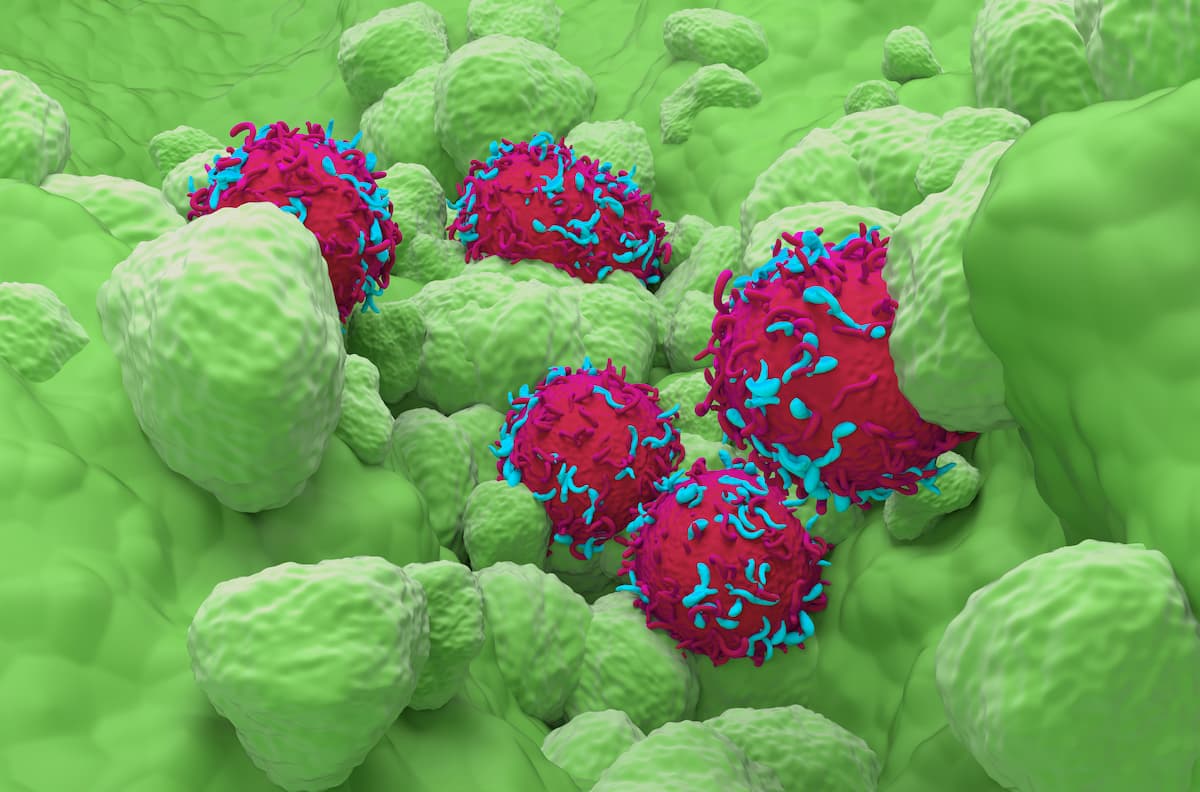 Sunvozertinib Approved by FDA as Oral Treatment of NSCLC With EGFR Exon 20 Insertion Mutations