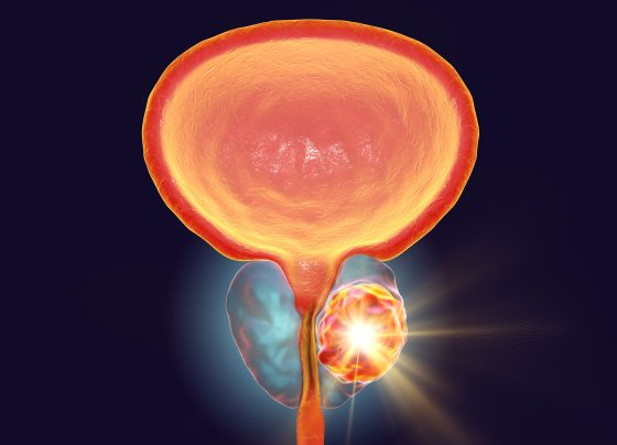 tre-5151-receives-fda-fast-track-designation-in-combination-with-radiation-therapy-for-prostate-cancer