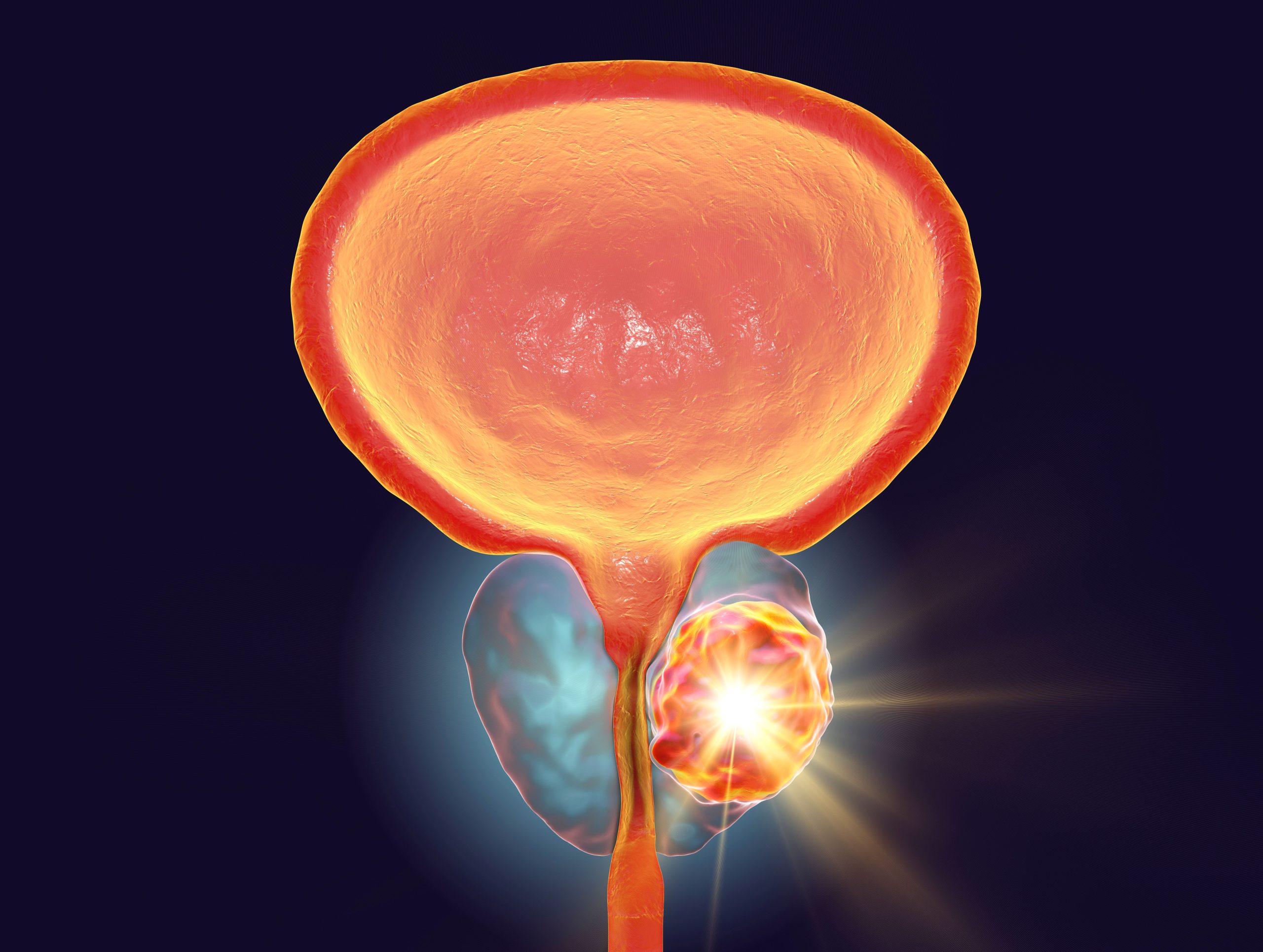 TRE-5151 Receives FDA Fast Track Designation in Combination With Radiation Therapy for Prostate Cancer