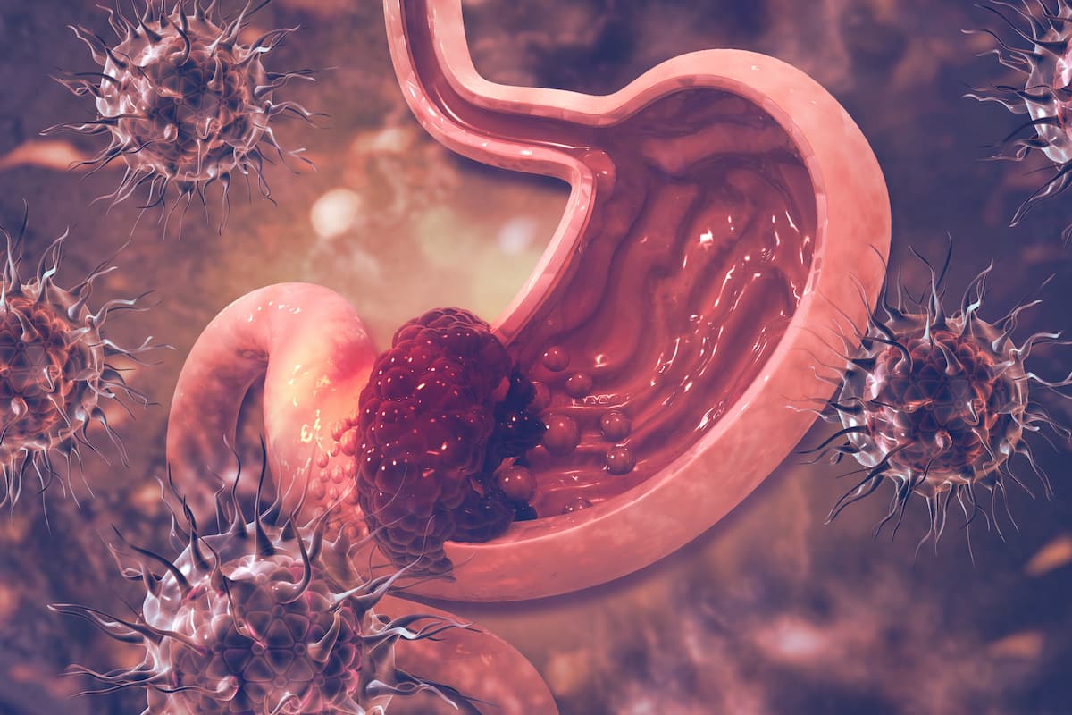 Bemarituzumab Elicits Positive Overall Survival in FGFR2b-Positive First-Line Gastric Cancer