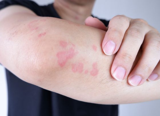 follow-up-study-confirms-omlyclo-biosimilarity-to-xolair-in-treatment-of-csu