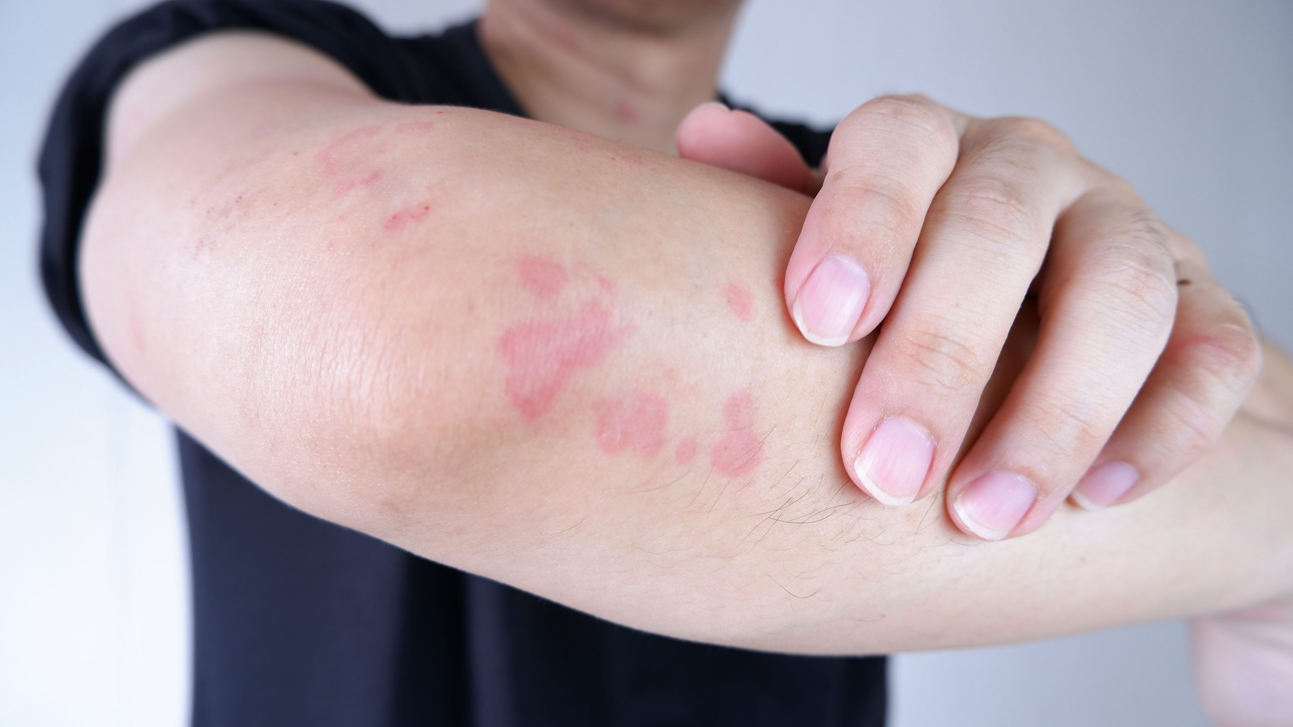 Follow-Up Study Confirms Omlyclo Biosimilarity to Xolair in Treatment of CSU