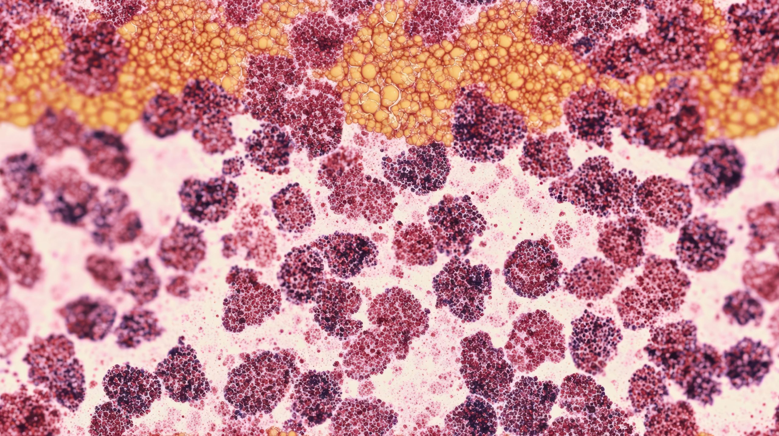 FDA Issues Complete Response Letter for Glofit-GemOx in R/R DLBCL