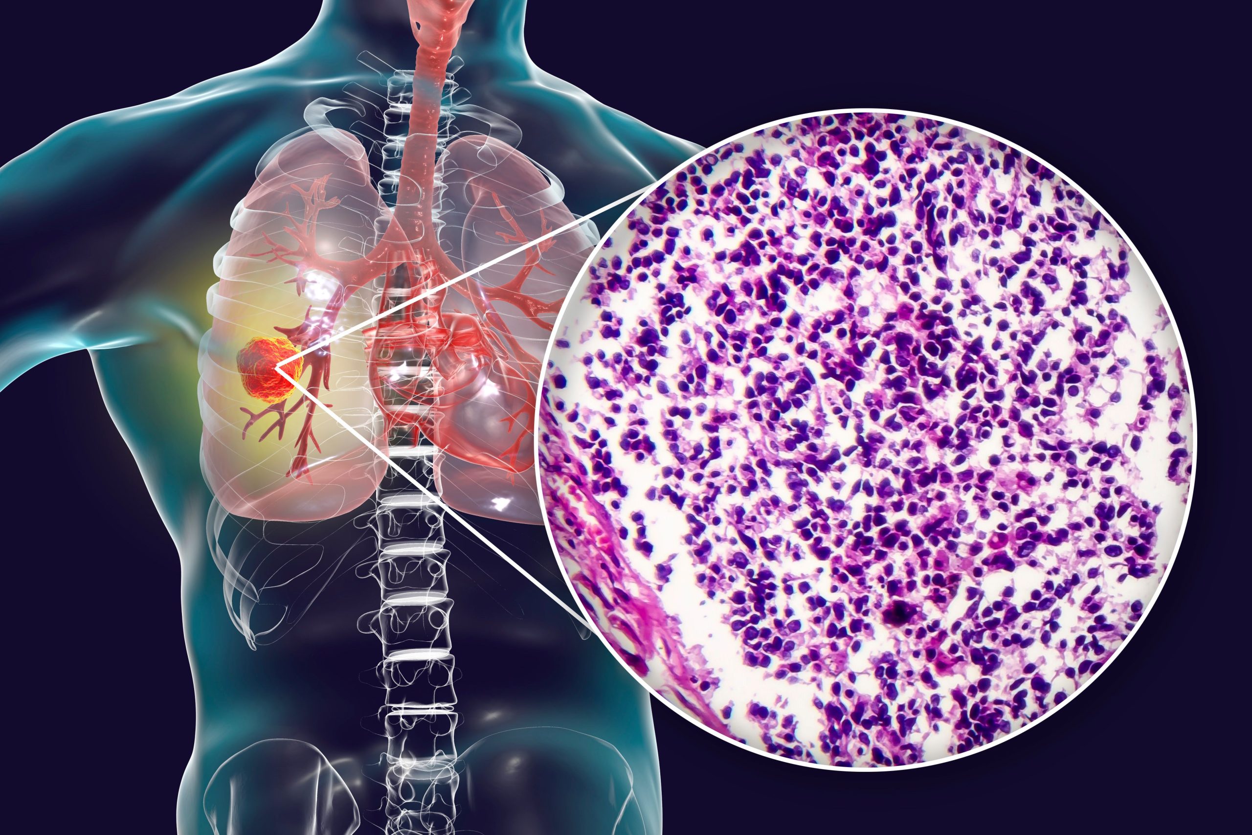 Nuvalent Initiates Phase 3 ALKAZAR Trial of Neladalkib in NSCLC