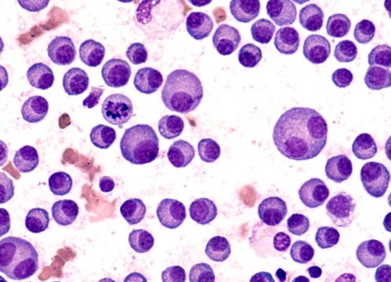 eha-2025:-early-data-support-tocilizumab-use-to-enable-outpatient-talquetamab-dosing-in-r/r-multiple-myeloma