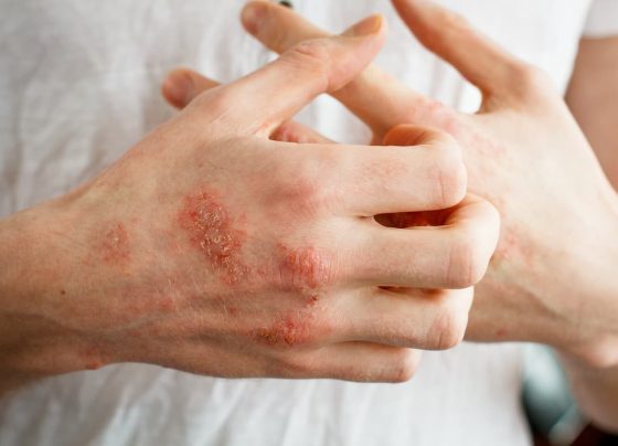 delgocitinib-cream-becomes-first,-only-approved-treatment-for-moderate-to-severe-chronic-hand-eczema
