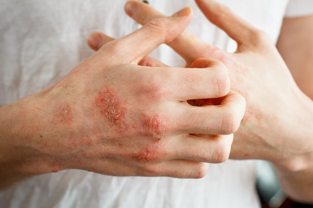 Delgocitinib Cream Becomes First, Only Approved Treatment for Moderate-to-Severe Chronic Hand Eczema