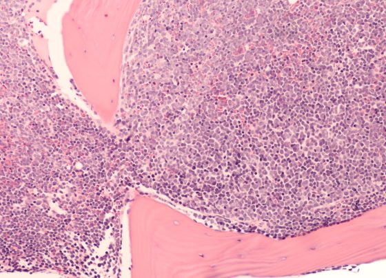 eha-2025:-golca-plus-rituximab-shows-promise-in-r/r-dlbcl