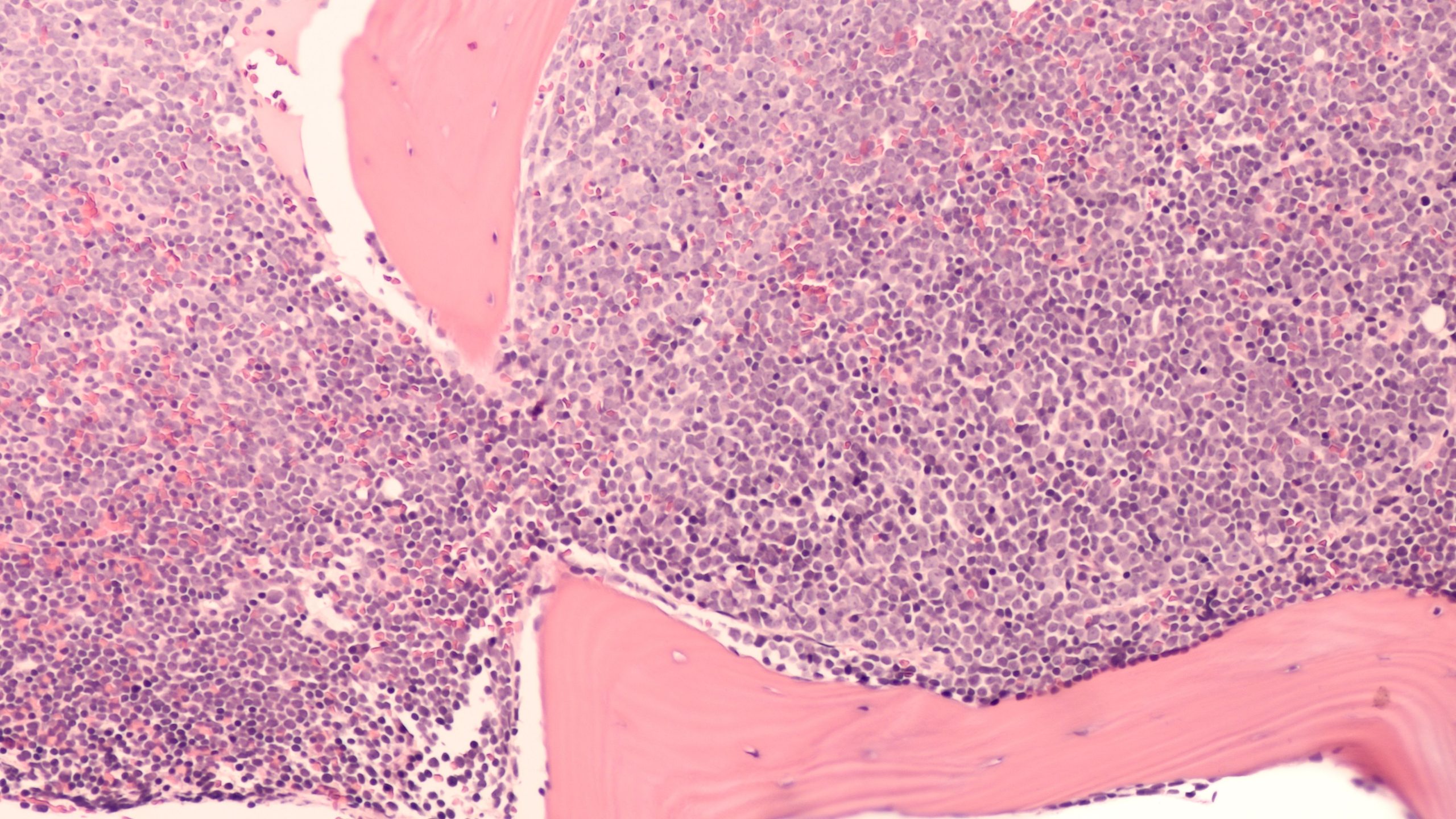 EHA 2025: GOLCA Plus Rituximab Shows Promise in R/R DLBCL