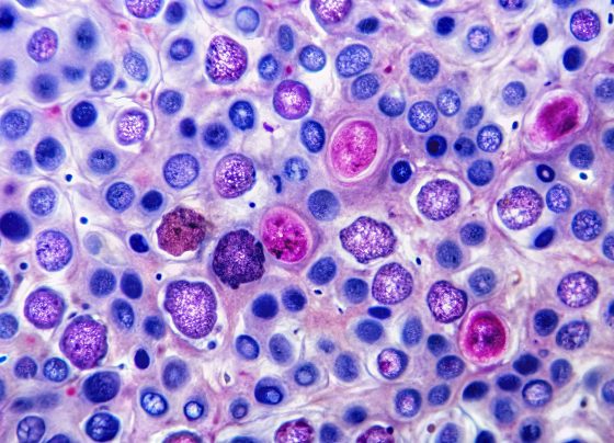 eha-2025:-golcadomide-shows-deep-responses-in-high-risk-follicular-lymphoma
