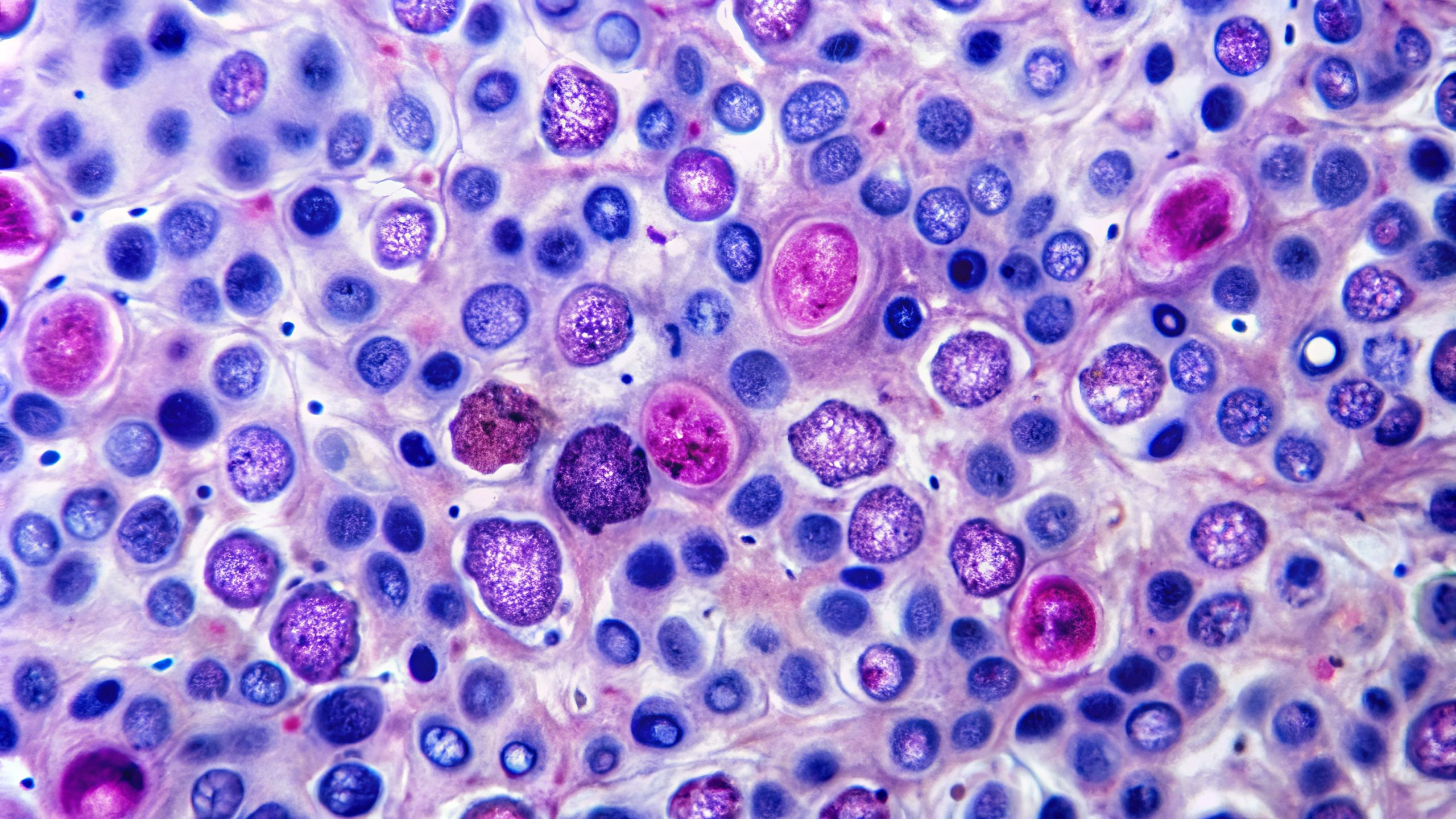 EHA 2025: Golcadomide Shows Deep Responses in High-Risk Follicular Lymphoma