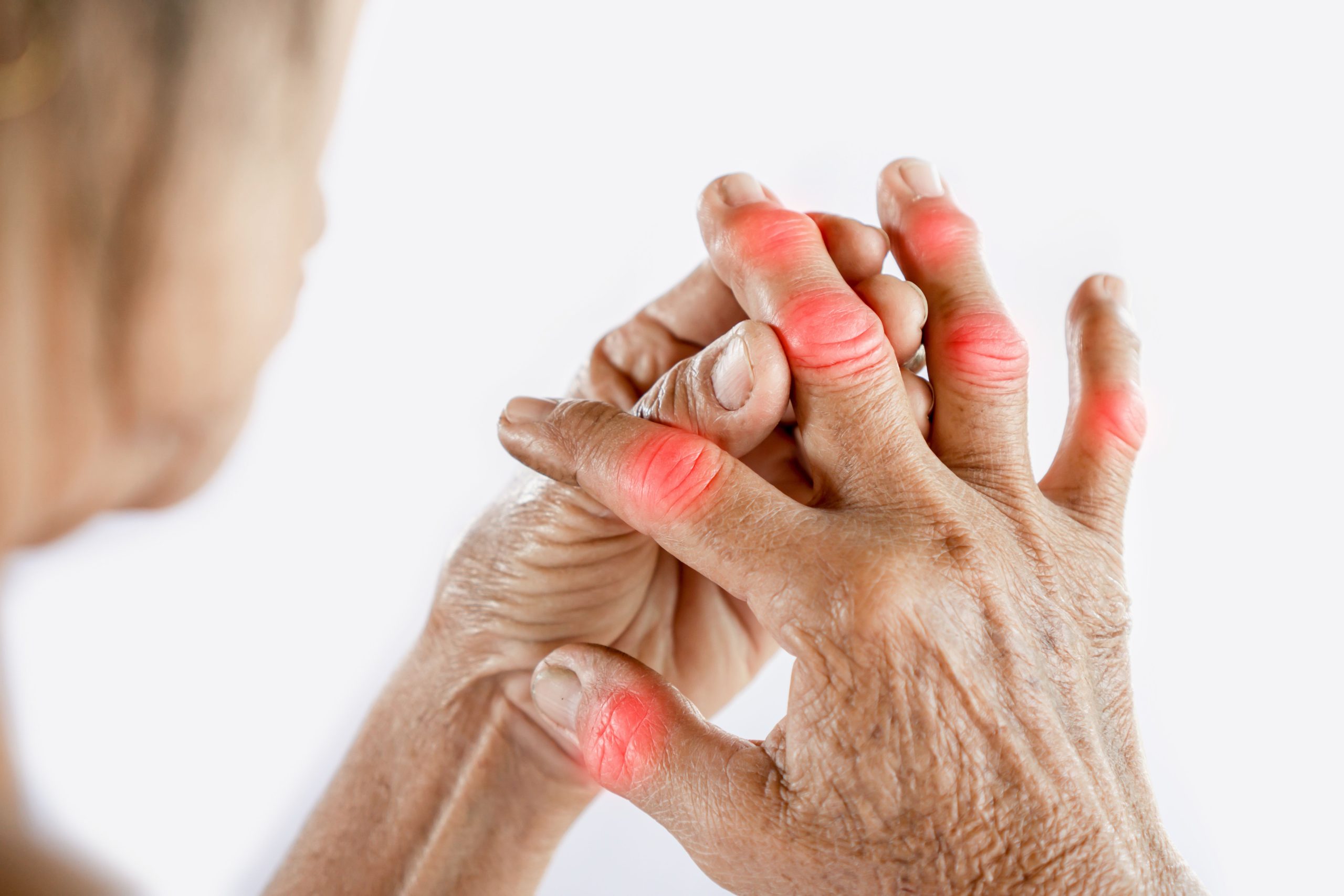 Omega-3 Fatty Acids and Vitamin D Improves Inflammatory Biomarkers in Rheumatoid Arthritis