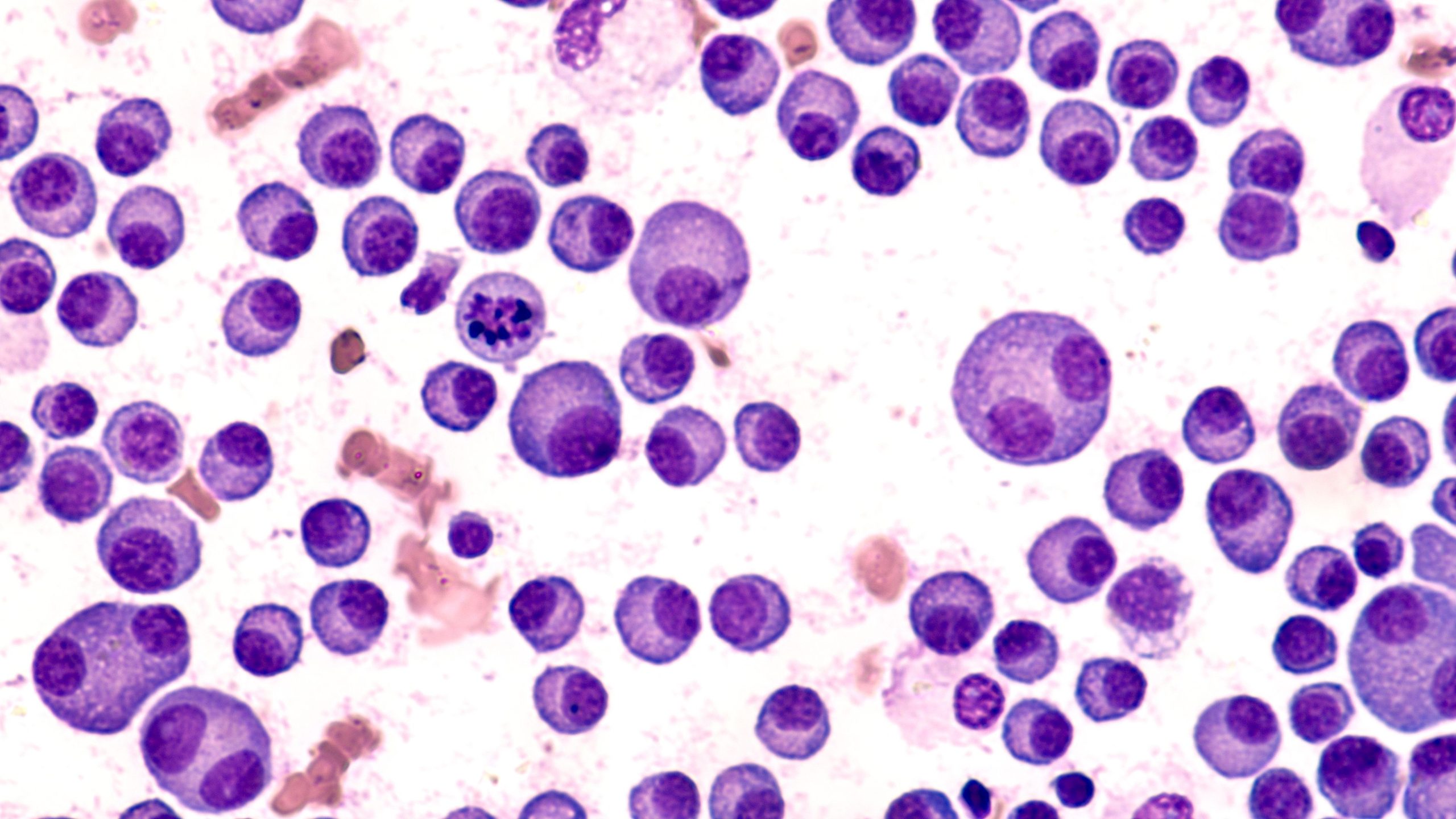 Expert: Linvoseltamab’s Simplified Dosing Expands Access, Enhances Tolerability in Multiple Myeloma