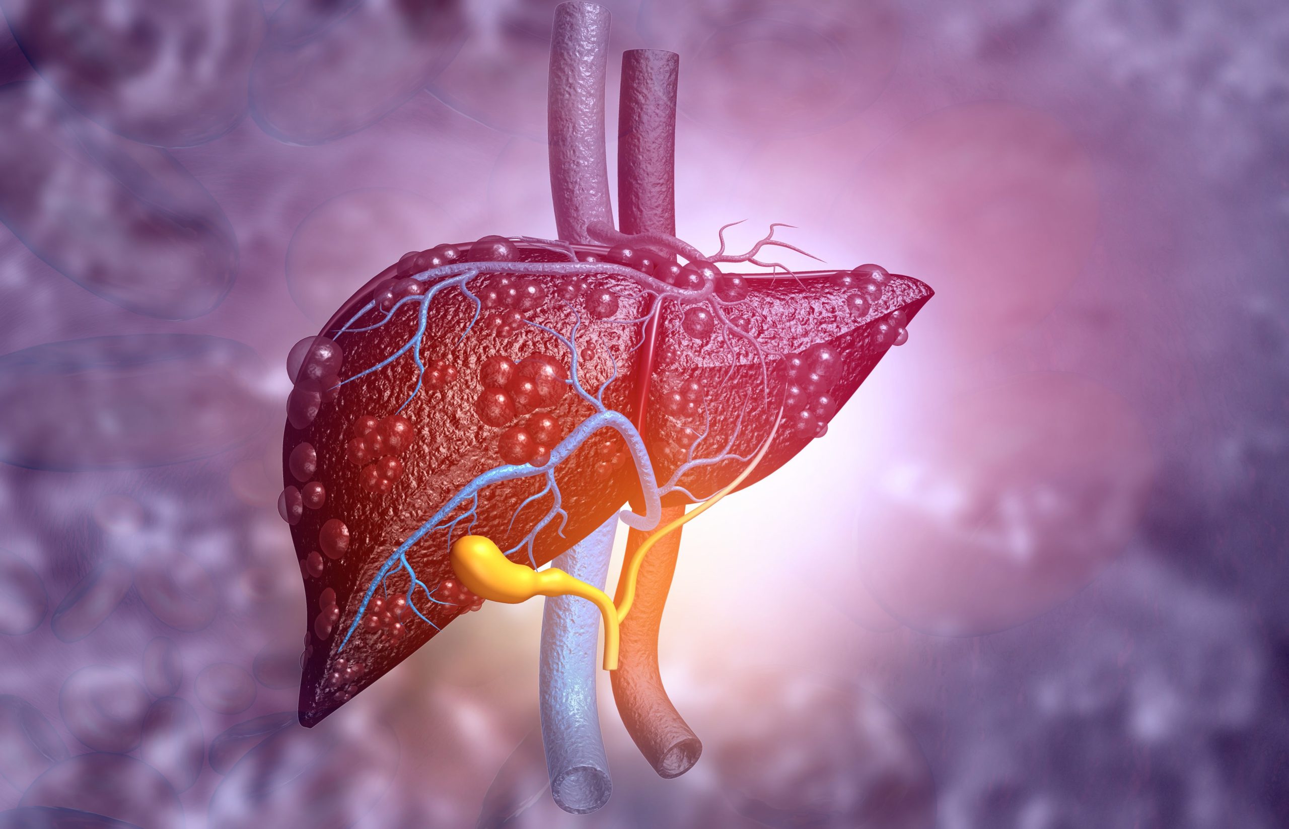 Updated European MASLD Guidelines Review Prevention, Screening, and Treatments