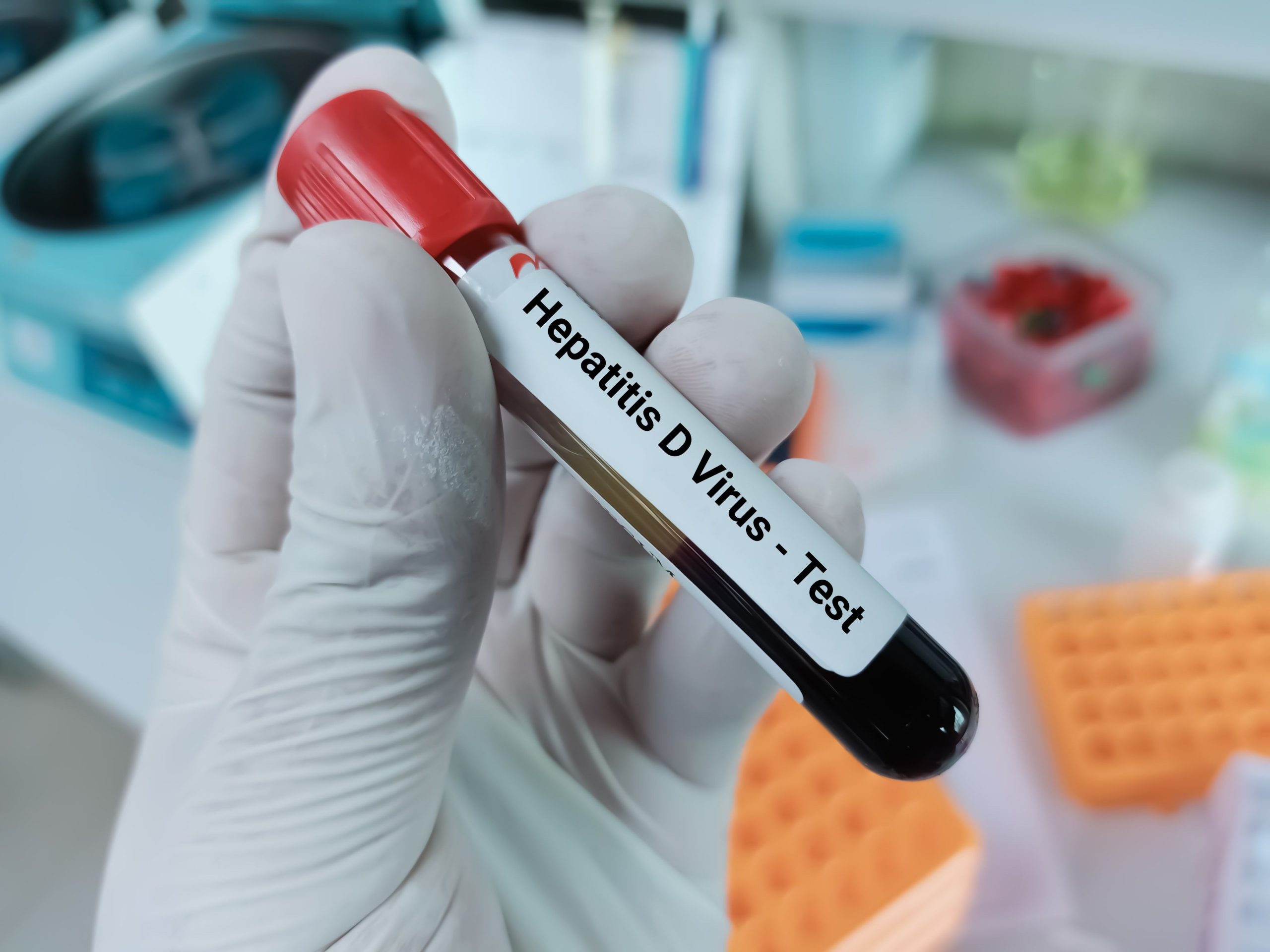 Hepatitis D Reclassified as Carcinogenic, According to WHO