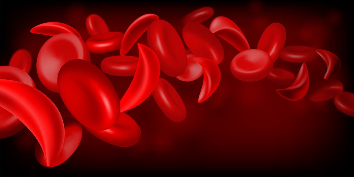 Changing the Course of SCD: One Dose of Hydroxyurea at a Time