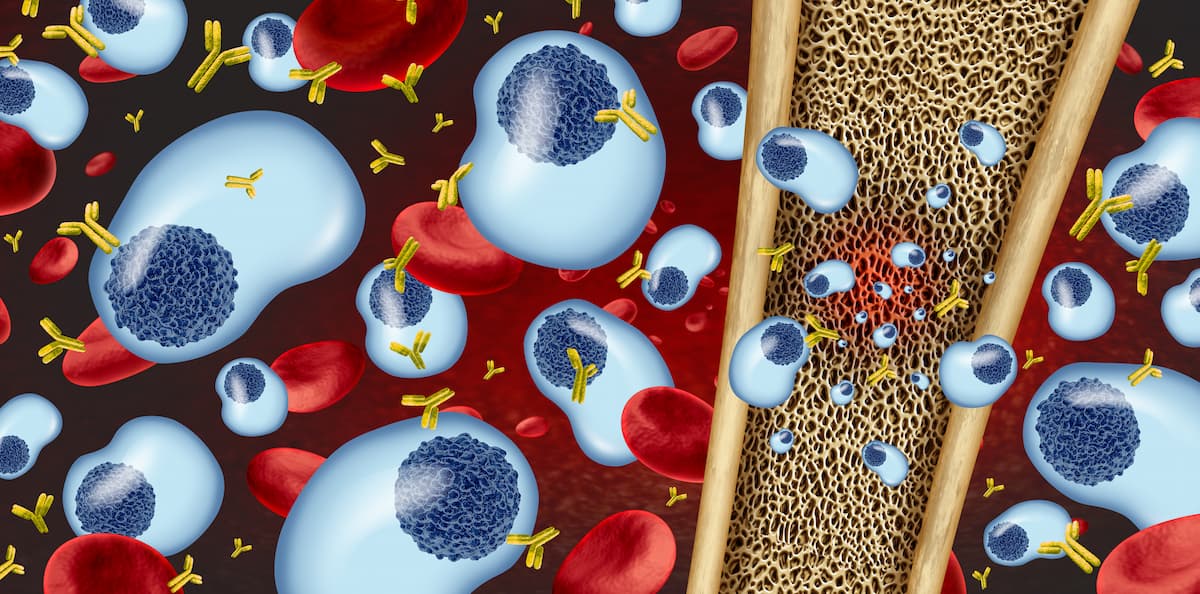 Multiple Myeloma: A Modern Look at an Ancient Disease and 2025’s Therapeutic Breakthroughs