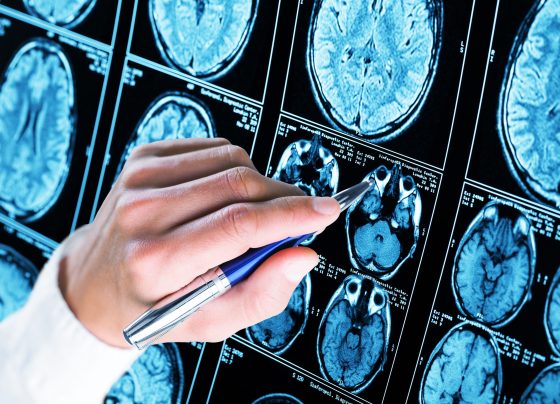 donanemab-azbt-demonstrated-long-term-efficacy-in-slowing-cognitive-decline