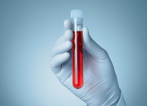 blood-test-could-replace-bone-marrow-biopsies-in-multiple-myeloma