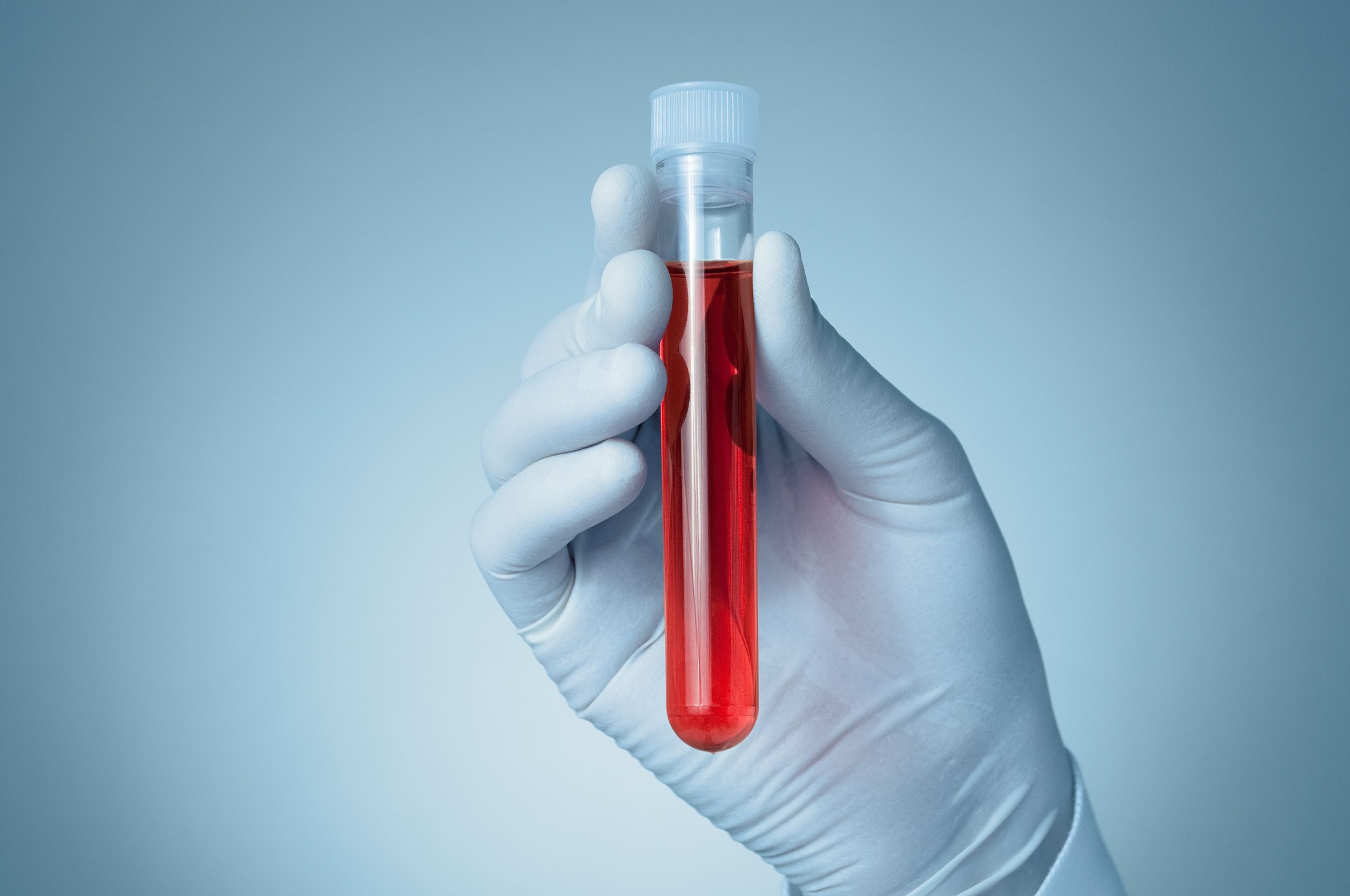 Blood Test Could Replace Bone Marrow Biopsies in Multiple Myeloma