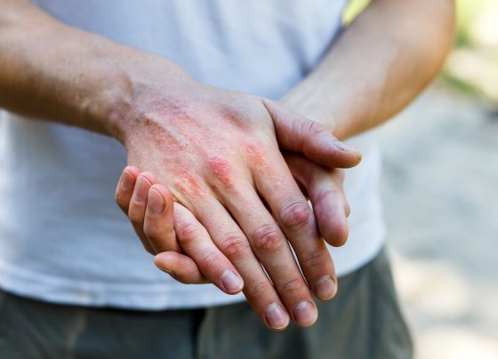 self-care-measures-for-prevention-and-management-of-contact-dermatitis