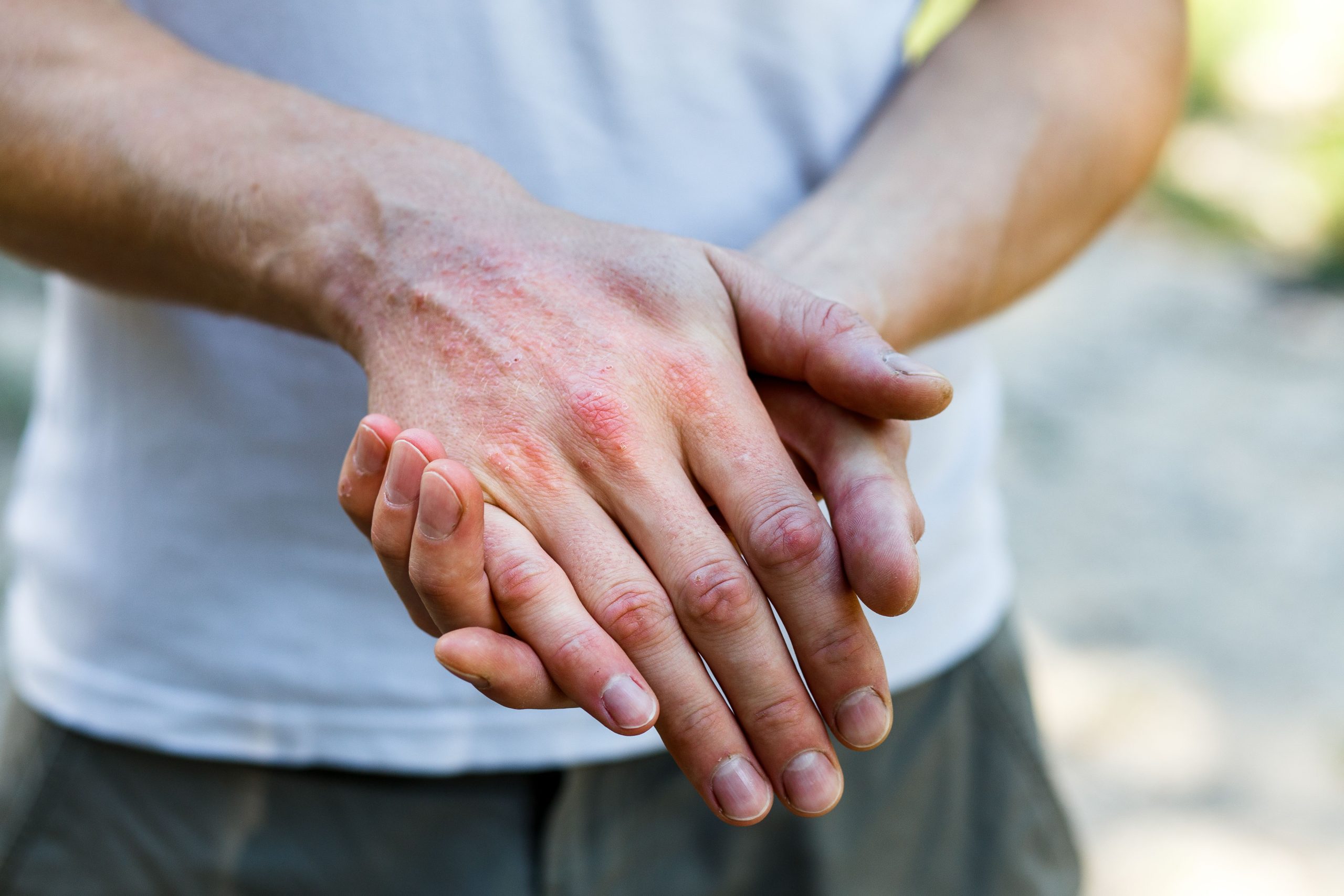 Self-Care Measures for Prevention and Management of Contact Dermatitis