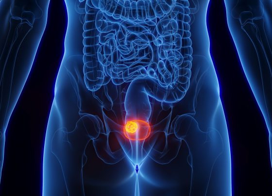 tar-200-clears-tumors-in-82%-of-patients-with-bcg-unresponsive-non–muscle-invasive-bladder-cancer