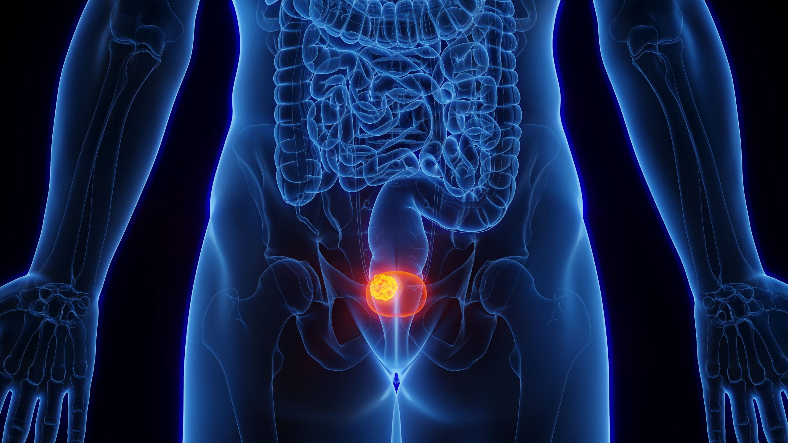 TAR-200 Clears Tumors in 82% of Patients With BCG-Unresponsive Non–Muscle-Invasive Bladder Cancer