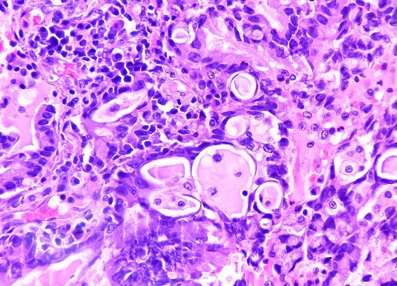 high-perilipin-2-expression-associated-with-disease-progression,-shorter-survival-in-lung-adenocarcinoma