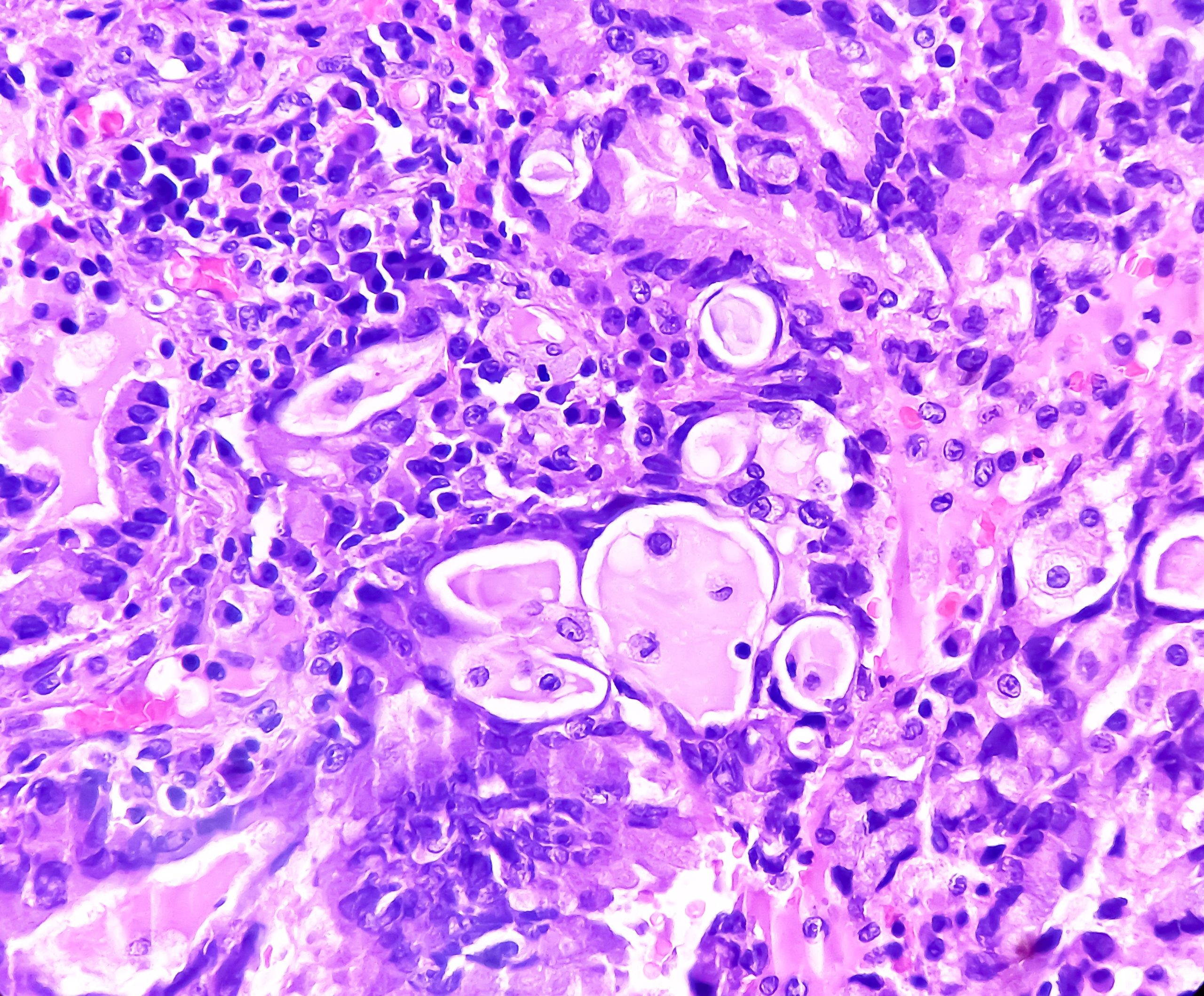 High Perilipin 2 Expression Associated With Disease Progression, Shorter Survival in Lung Adenocarcinoma