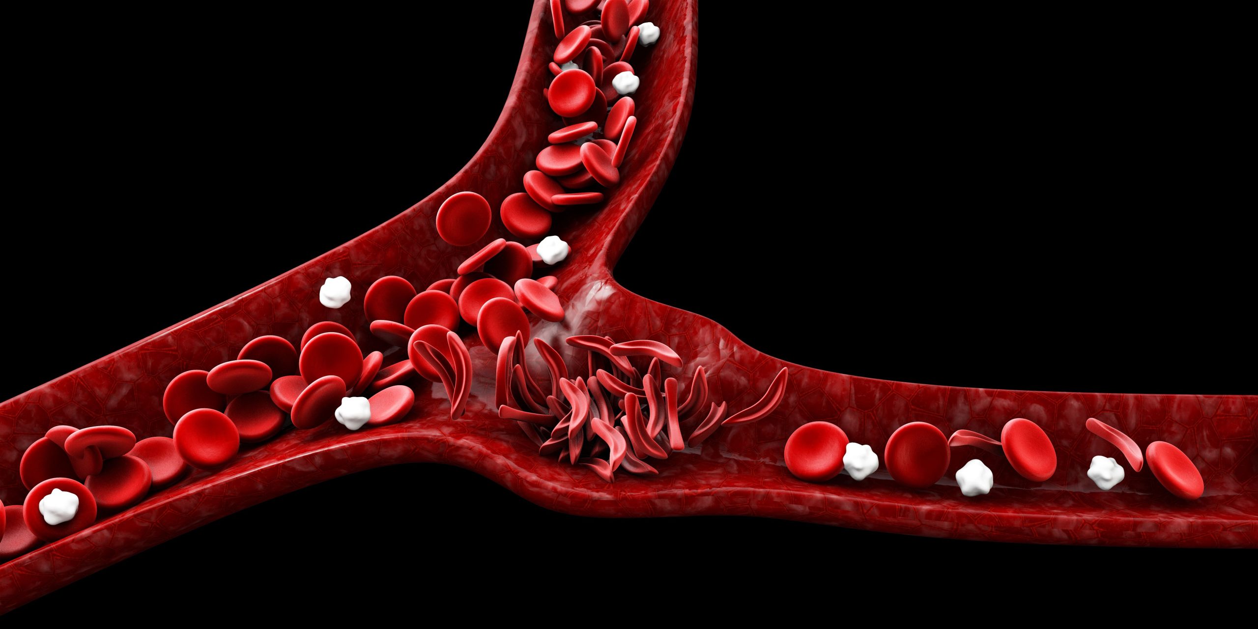 BEAM-101 Receives RMAT for the Treatment of Sickle Cell Disease