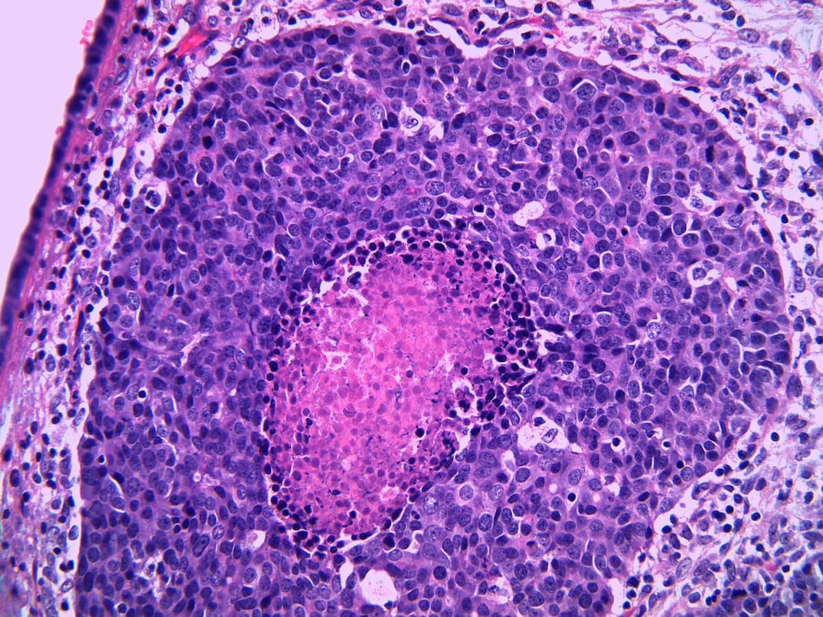Antibody-Drug Conjugates Poised to Revolutionize Treatment of Urothelial Carcinoma