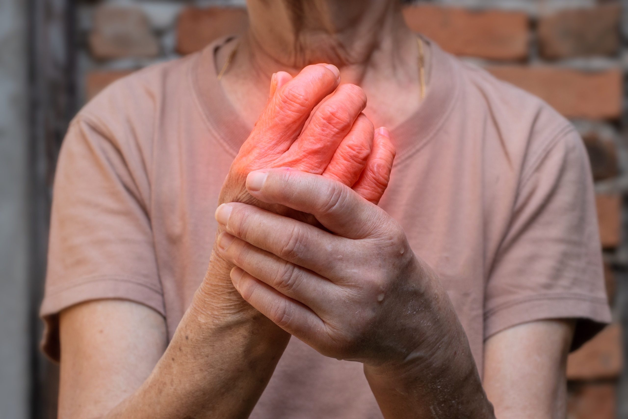 FDA Approves Donidalorsen as First RNA-Targeted Prophylactic Treatment for Hereditary Angioedema