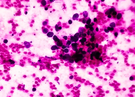 met-inhibitor-with-chemoimmunotherapy-overcomes-treatment-resistance-in-some-patients-with-sclc