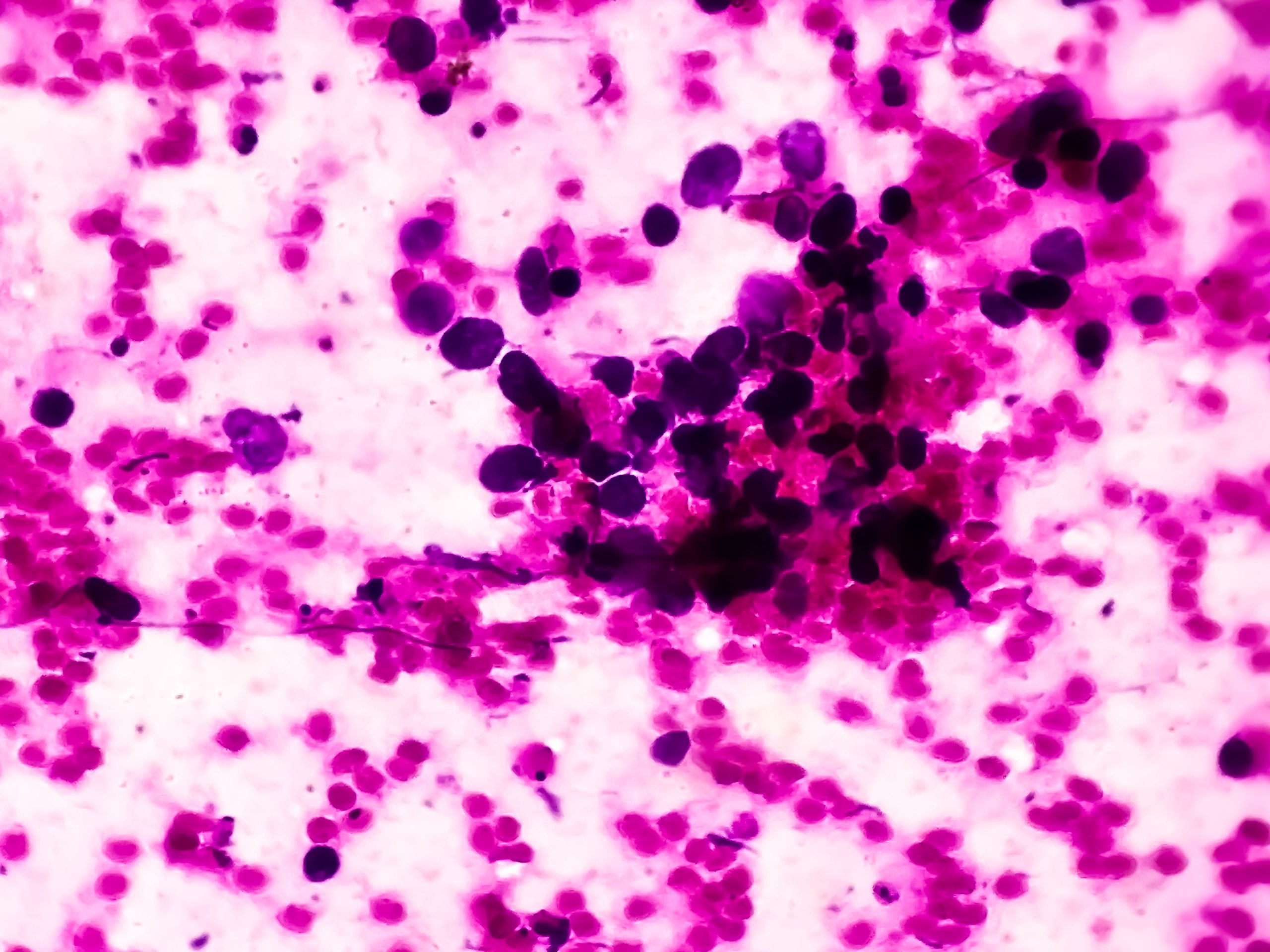 MET Inhibitor With Chemoimmunotherapy Overcomes Treatment Resistance in Some Patients With SCLC