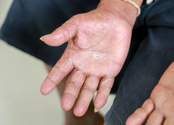 patients-with-systemic-sclerosis-face-decreased-hdl-c,-increased-lipoprotein(a)