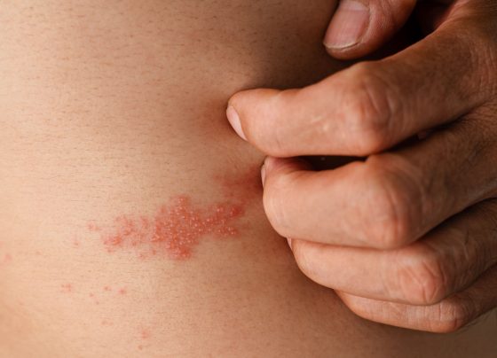 dynavax’s-z-1018-shingles-vaccine-candidate-shows-promising-immune-response-and-safety-in-early-trial