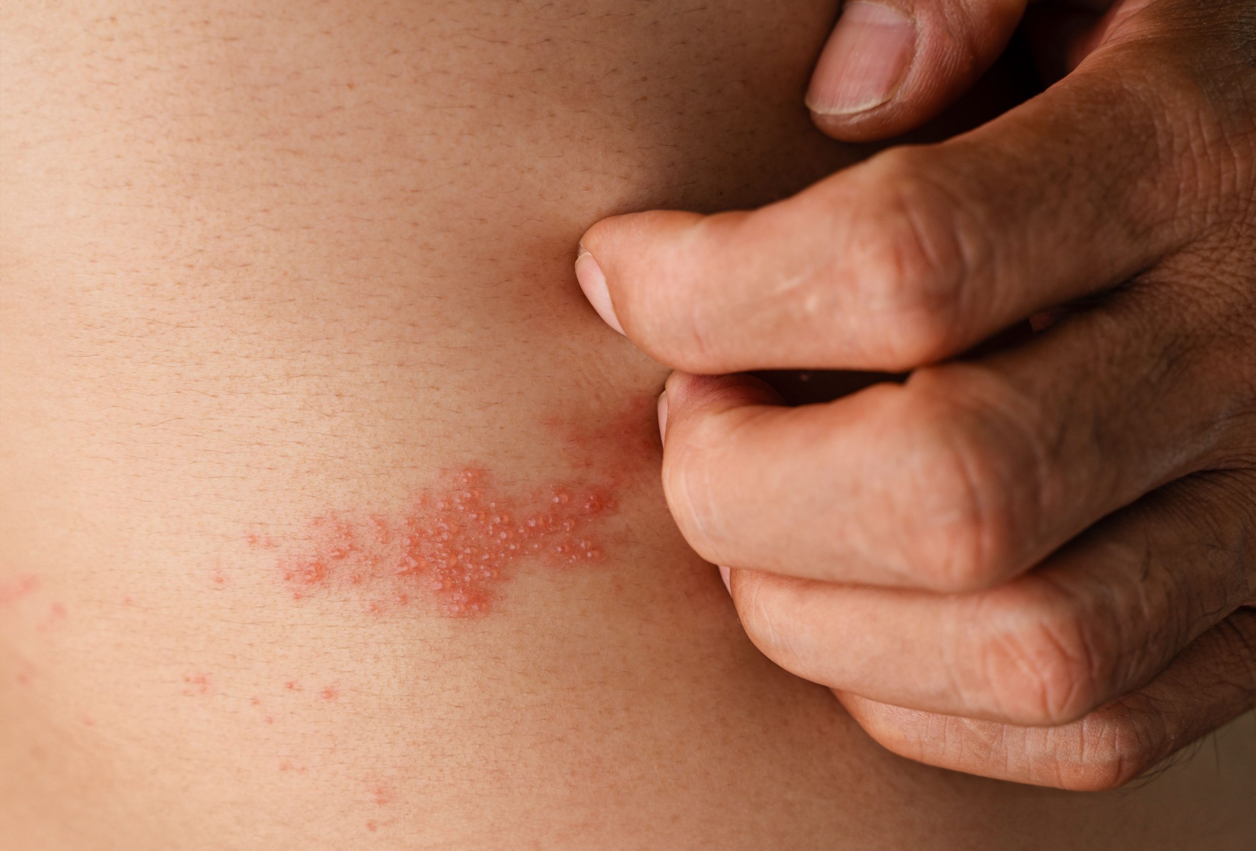 Dynavax’s Z-1018 Shingles Vaccine Candidate Shows Promising Immune Response and Safety in Early Trial