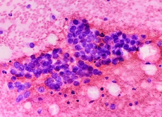 fda-grants-i-dxd-breakthrough-therapy-designation-in-treatment-of-es-sclc